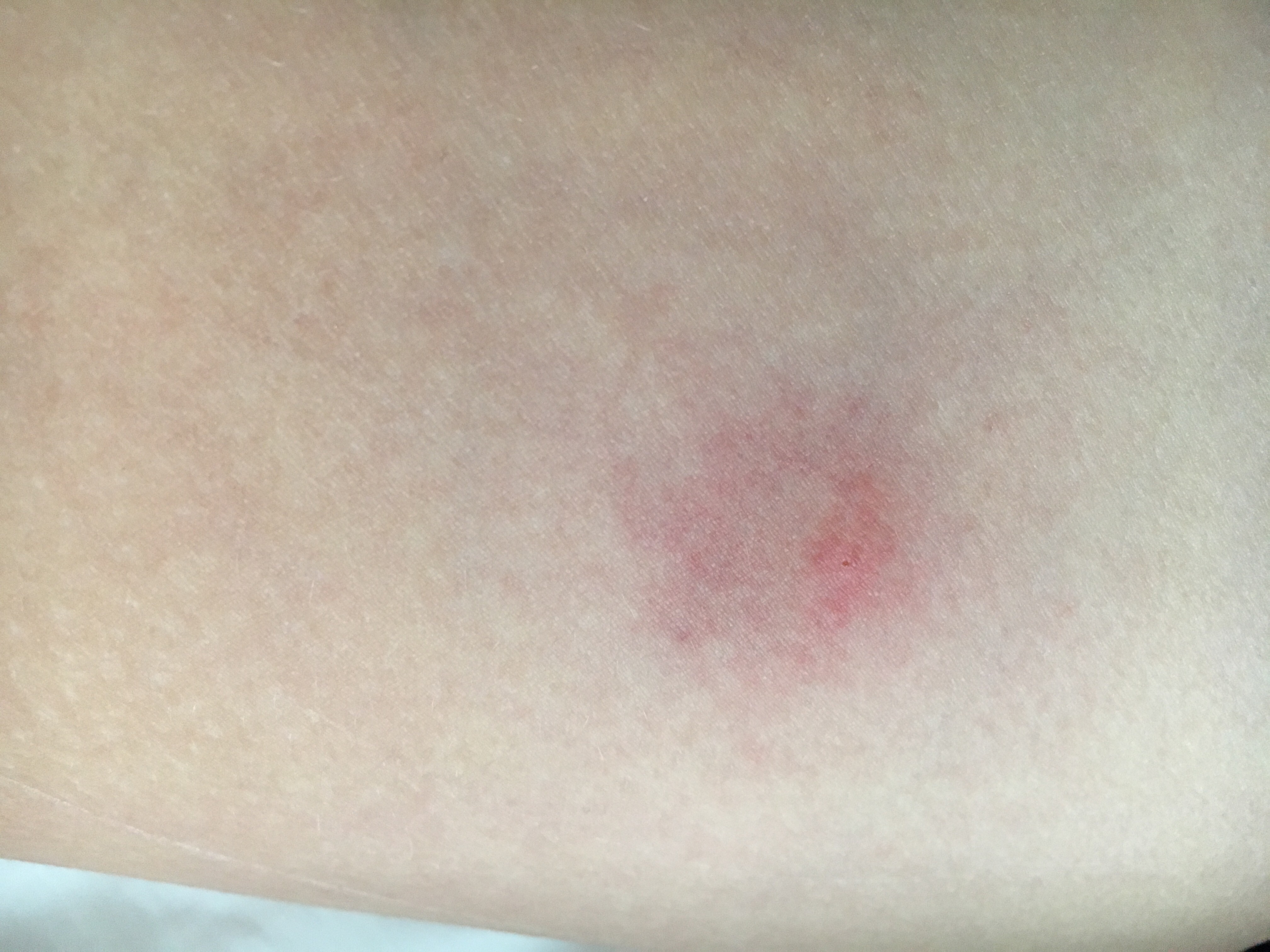 Ist das ein zeckenbiss oder borreliose? (Arzt)